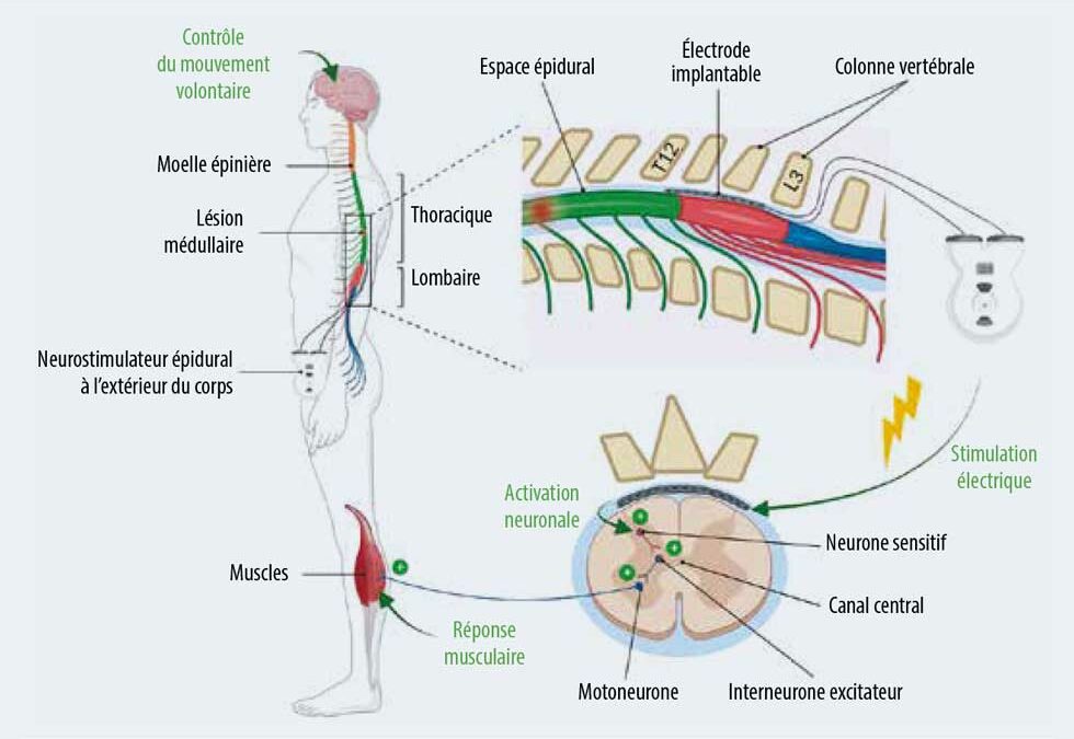 Publication dans “La lettre du neurologue” de septembre 2023